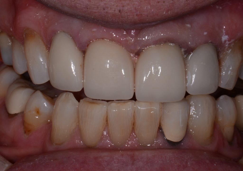 veneers